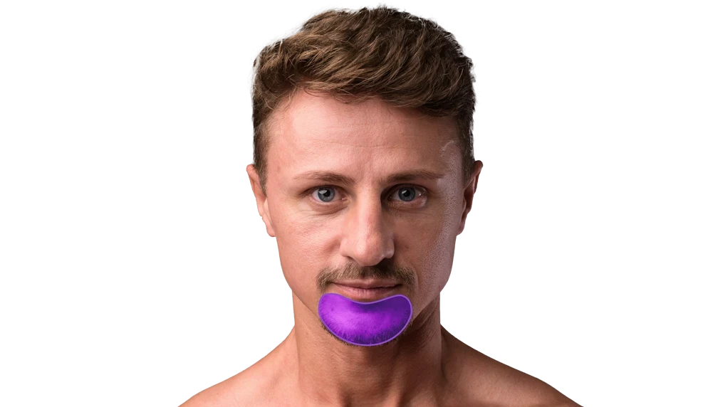 Лазерная эпиляция бороды