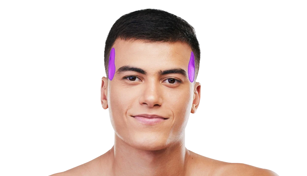 Лазерна епіляція бакенбардів