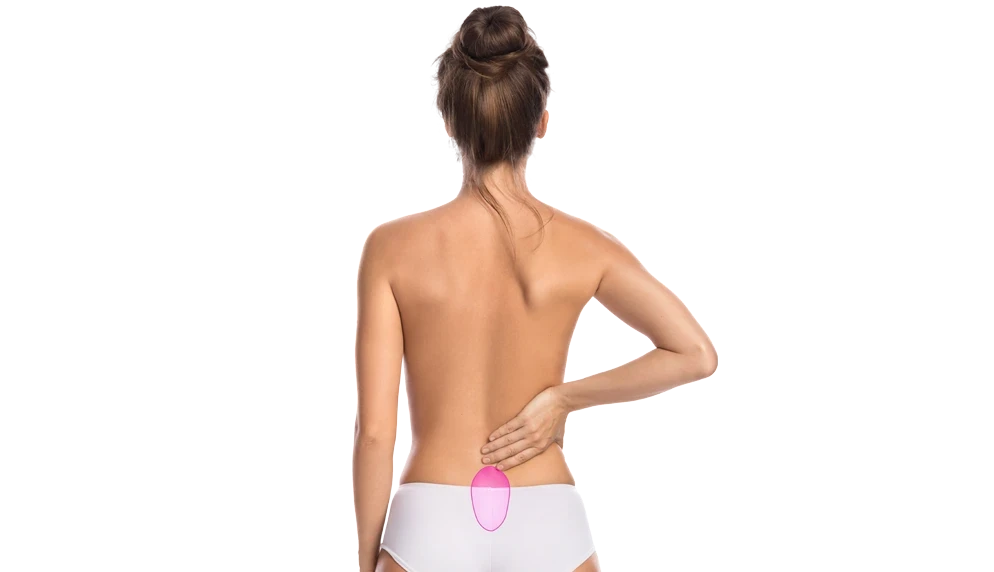 Лазерна епіляція куприка