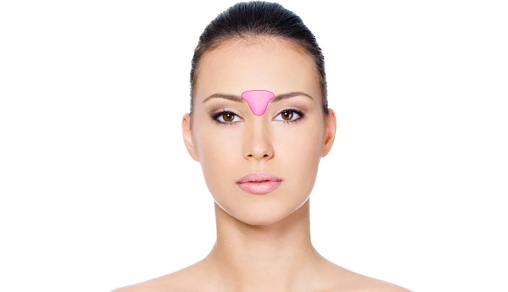 Лазерная эпиляция межбровья