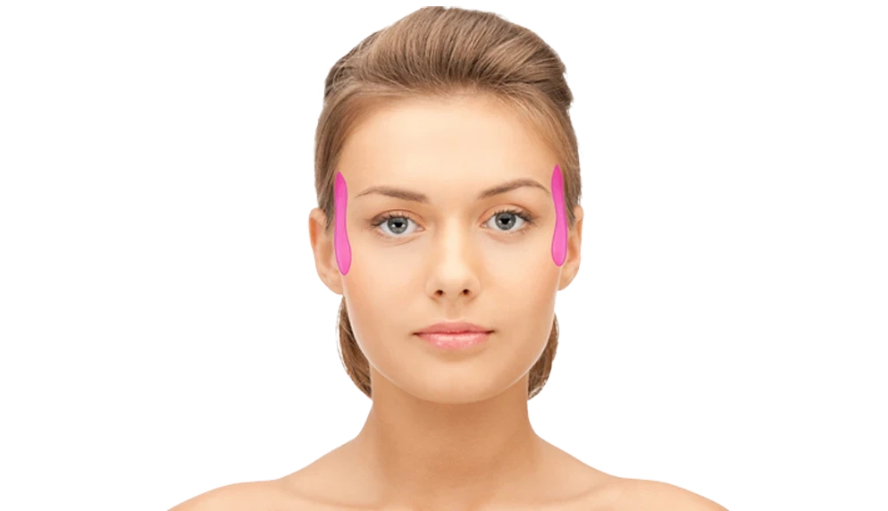 Лазерна епіляція скроней