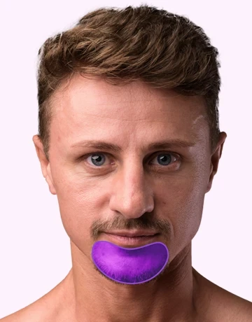 Лазерная эпиляция бороды