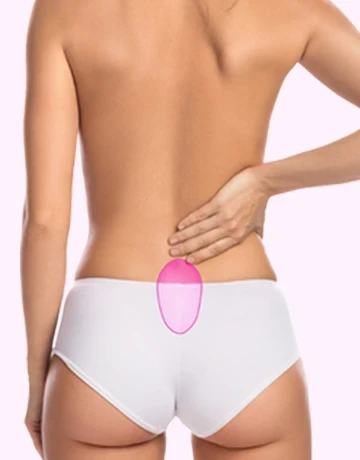 Лазерная эпиляция копчика